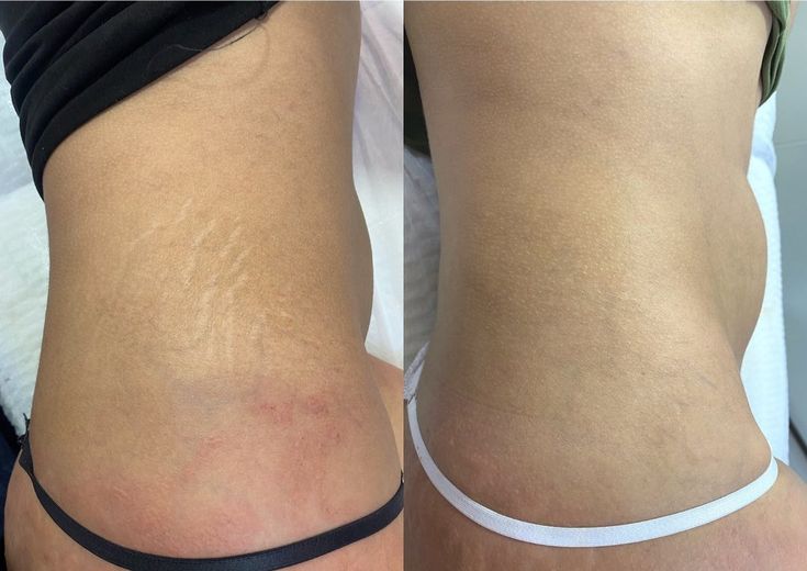 Antes y después: apariencia de estrías en el abdomen